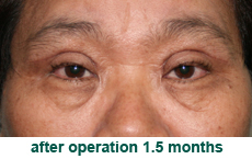 plastic-surgery-blepharoplasty